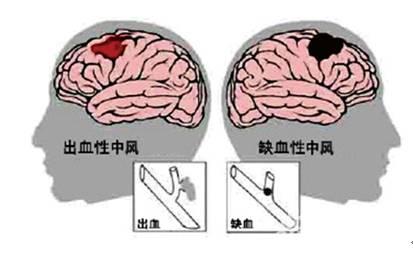 天呀！预防可怕的脑中风，原来这么简单！但还有很多人不知道