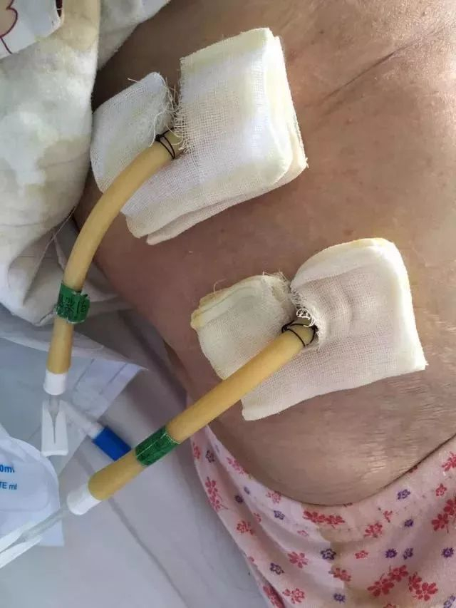 术后引流液疯狂外渗怎么办一个小妙招轻松帮你解决