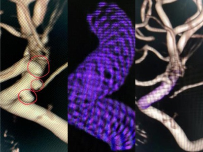 （左一图红色标记突起为动脉瘤，图中紫色为密网支架，右一的图为治疗后的脑部血管，动脉瘤已经完全清除）