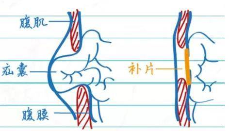 得了疝气怎么办?拖下去只会危及生命!|腹腔镜|手术_新浪新闻