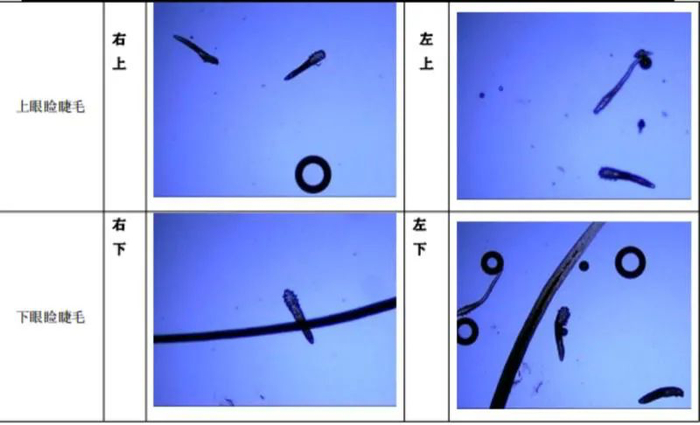 患者的螨虫检测报告/图片来源：医院提供
