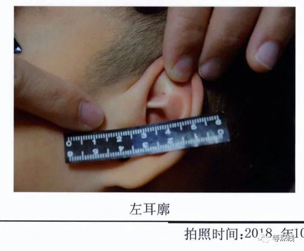 鉴定记录显示，一名儿童的左耳存在伤痕。&nbsp;受访者供图