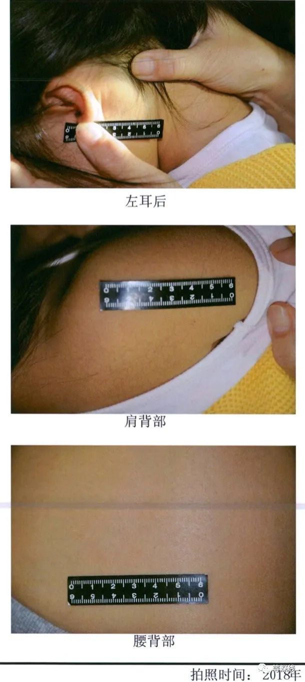 一名女童的鉴定记录显示，伤痕位置较为隐蔽。&nbsp;受访者供图