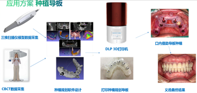 ▲3D打印应用于种植导板制作