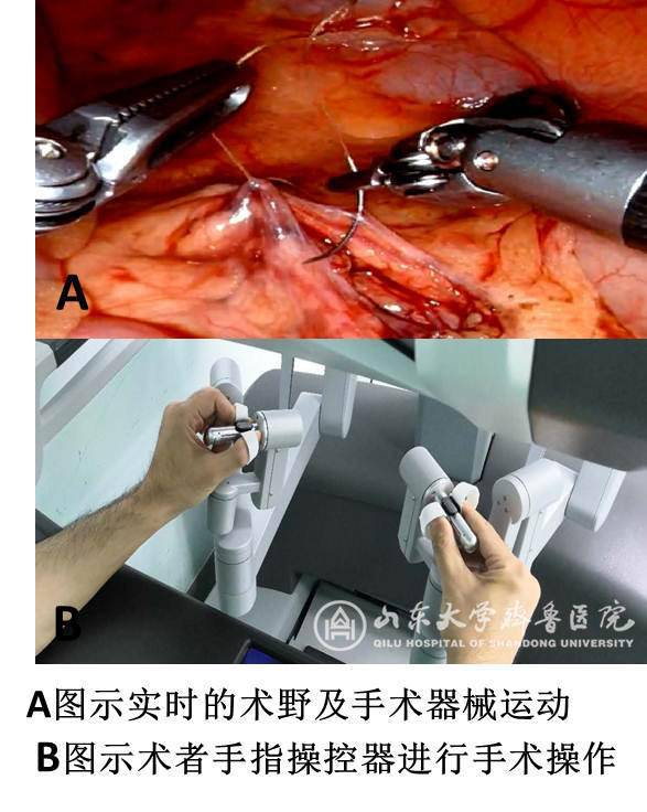 山东大学齐鲁医院利用达芬奇第四代xi机器人开展小儿肾盂成形术