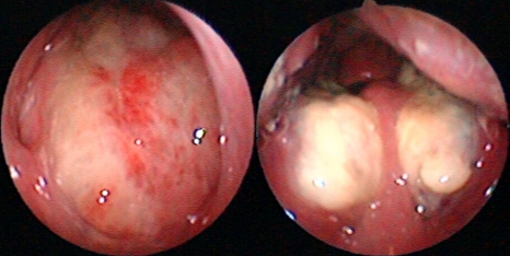 小乐的双侧扁桃体明显肿大，表面还有白色厚厚的伪膜覆盖。（通讯员供图）