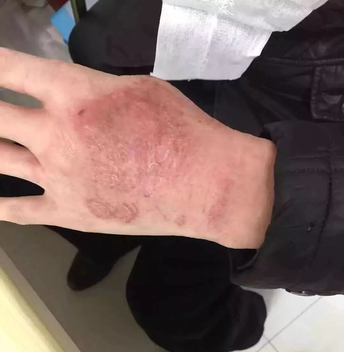 △武汉肺科医院检验科医生的手