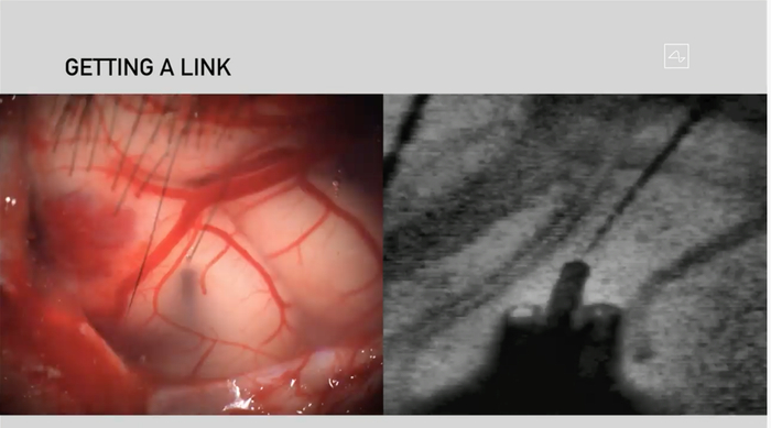 　　马斯克在直播中声称，Neuralink的最终潜力几乎是无限的，例如可以用心灵感应召唤一辆自动驾驶中的特斯拉。“可以解决失明、可以解决瘫痪、可以解决听力”。