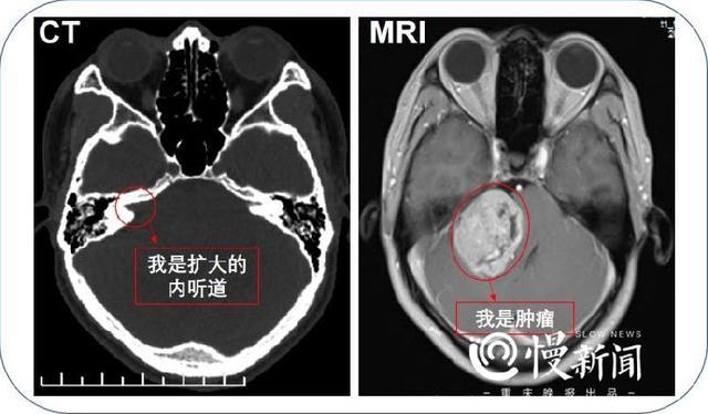 慢生活·健康丨听力下降耳鸣头晕……耳朵没有问题但脑袋里有问题