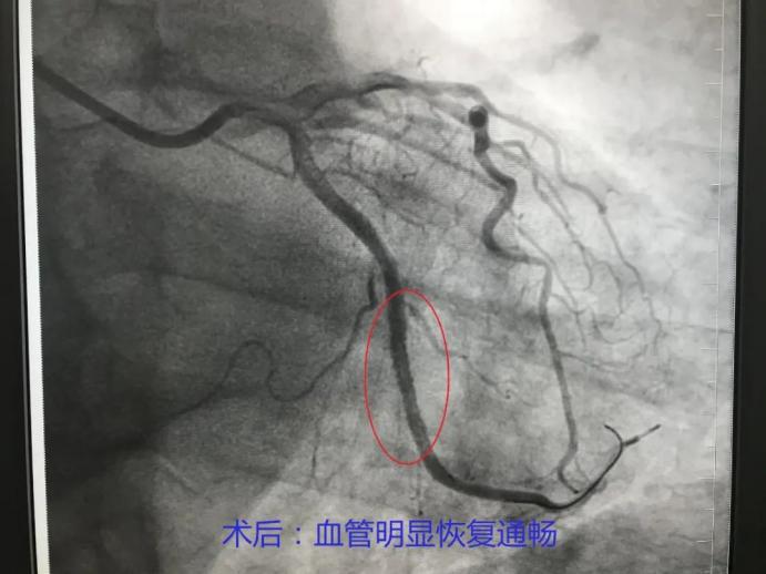上新台阶！重庆市东南医院首例心脏冠脉造影和心脏支架植入术成功开展