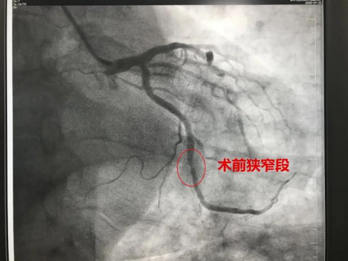 上新台阶！重庆市东南医院首例心脏冠脉造影和心脏支架植入术成功开展