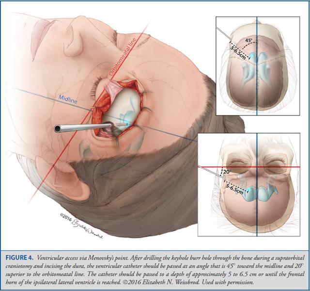 Operative Neurosurgery：颅骨测量与脑室穿刺