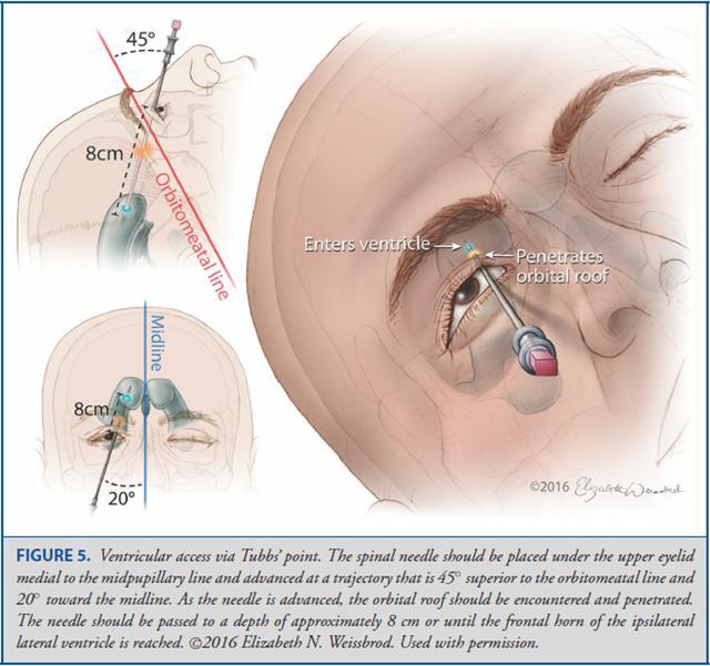 Operative Neurosurgery：颅骨测量与脑室穿刺