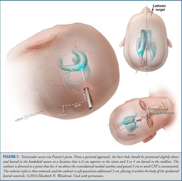 Operative Neurosurgery：颅骨测量与脑室穿刺