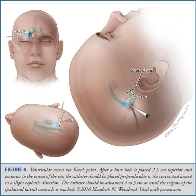 Operative Neurosurgery：颅骨测量与脑室穿刺