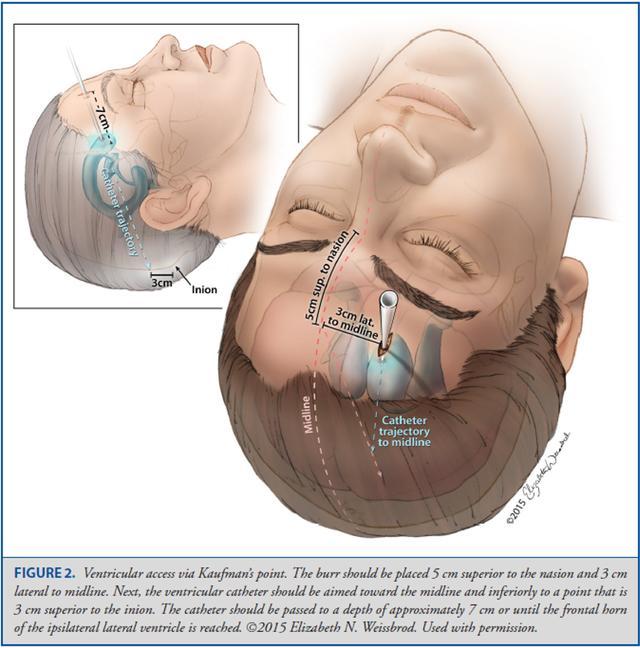 Operative Neurosurgery：颅骨测量与脑室穿刺