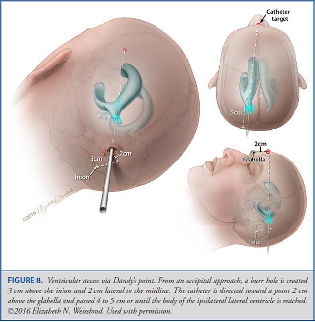 Operative Neurosurgery：颅骨测量与脑室穿刺