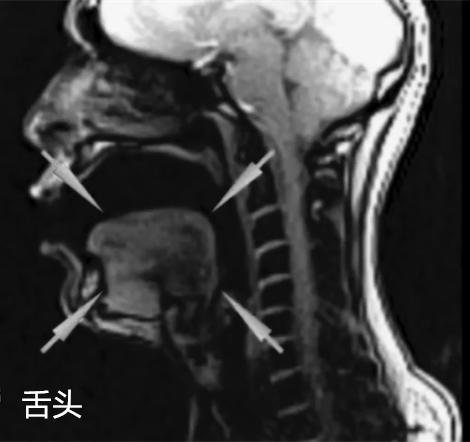 科学有意思 | 声音是如何从喉咙发出的？在核磁共振下唱歌试试