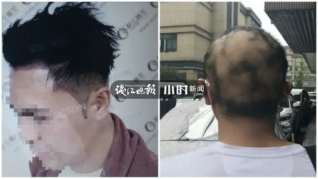 左图为小张一年前的发量，右图为脱发后的小张