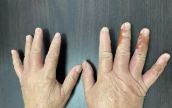 捡拾白果后，刘女士双手长出不规则的棕色印记（图片来源：掌上长沙）