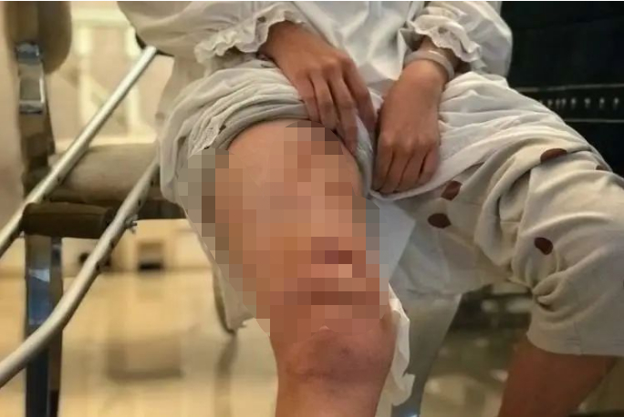 △陈女士被咬伤的伤口