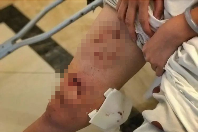 △陈女士被咬伤的伤口