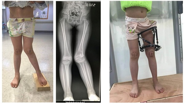 图说：小龙的右下肢就可以延长10厘米 采访对象供图