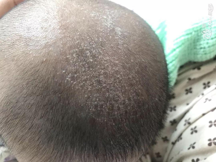 有种“无知”叫抠新生儿乳痂,乳痂是清干净了,却把孩子送进医院