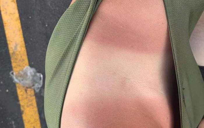 24日，关宏予发的晒黑图。受访者供图