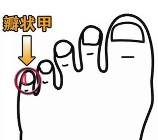 周围脚趾上的小趾甲分成两瓣的人,他们究竟什么特殊来历?