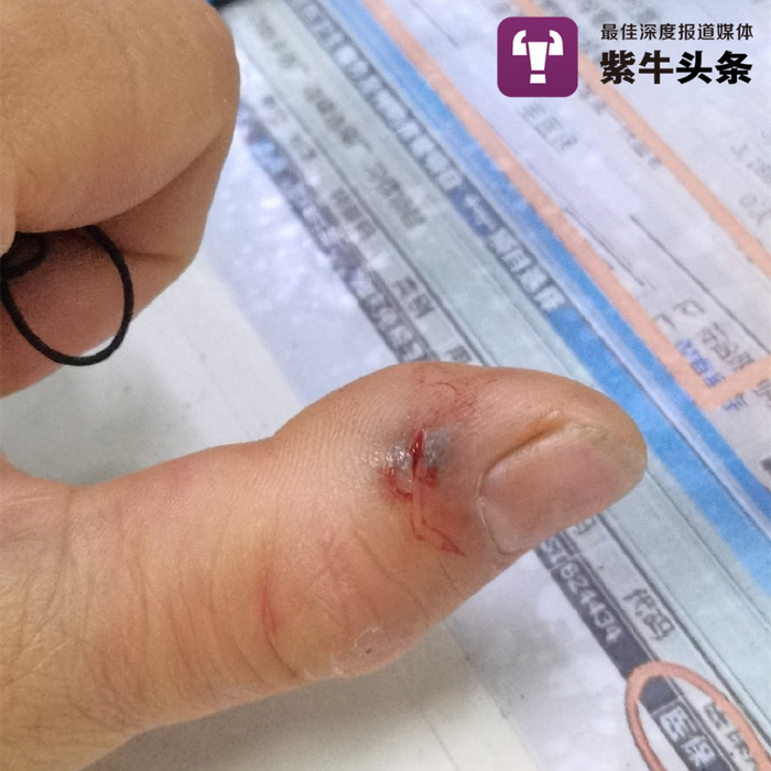 刚到医院时，蒋可威的手伤情况