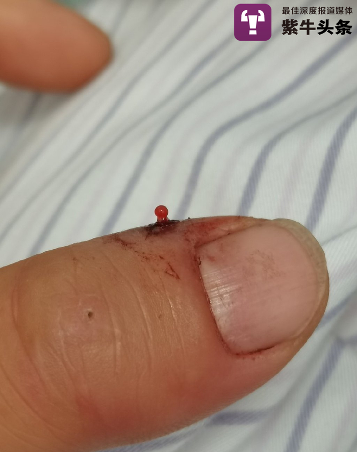 蒋可威被咬伤的手