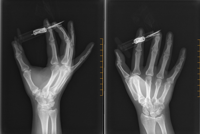 急诊拍X线片两张｜作者供图