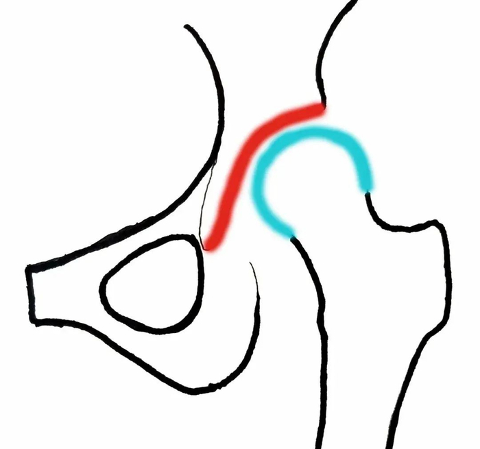 上图为髋关节发育不良，髋臼“碗”变浅，呈“盘子”样形状，股骨头“球”在“盘子”上不稳当。