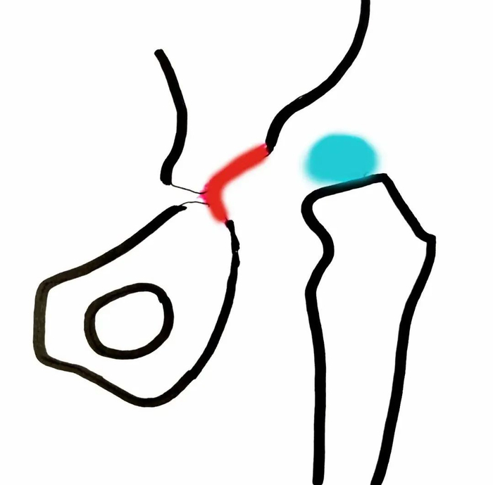 上图为髋关节完全脱位，股骨头“球”从髋臼“碗”中完全掉出来。