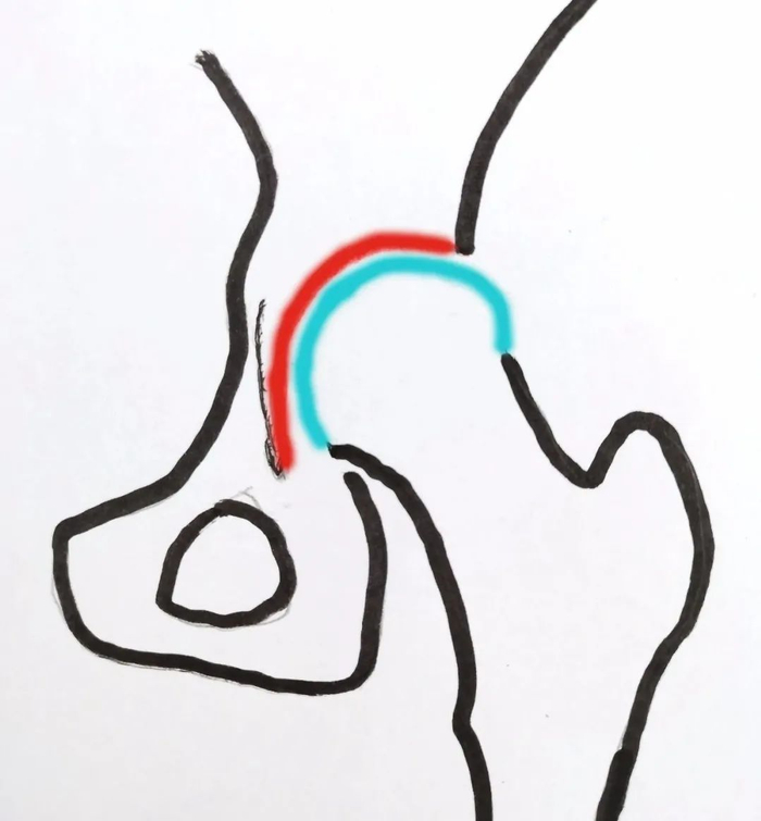 上图为正常髋关节，红色部分为髋臼，蓝色部分为股骨头。正常髋关节的髋臼“碗”深，股骨头“球”放在髋臼“碗”里稳稳当当。