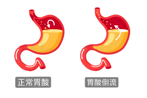 吃完饭就打嗝吐酸水？胃食管反流警惕食管癌！︱健康日历