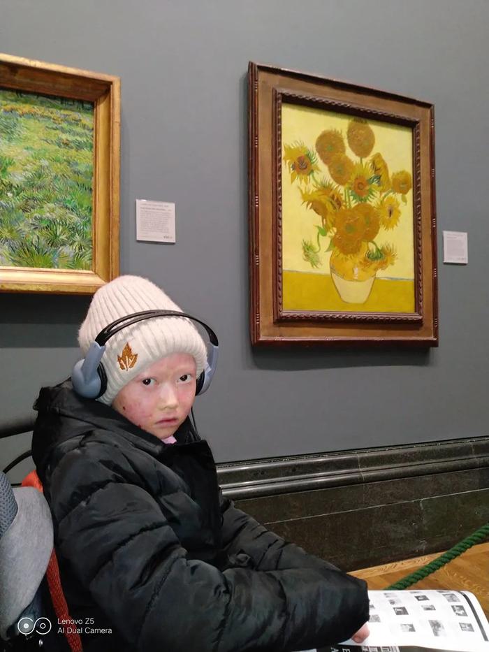 周密在北京被诊断为：大疱性表皮松解症中最严重的类型。本文图片均为受访者供图