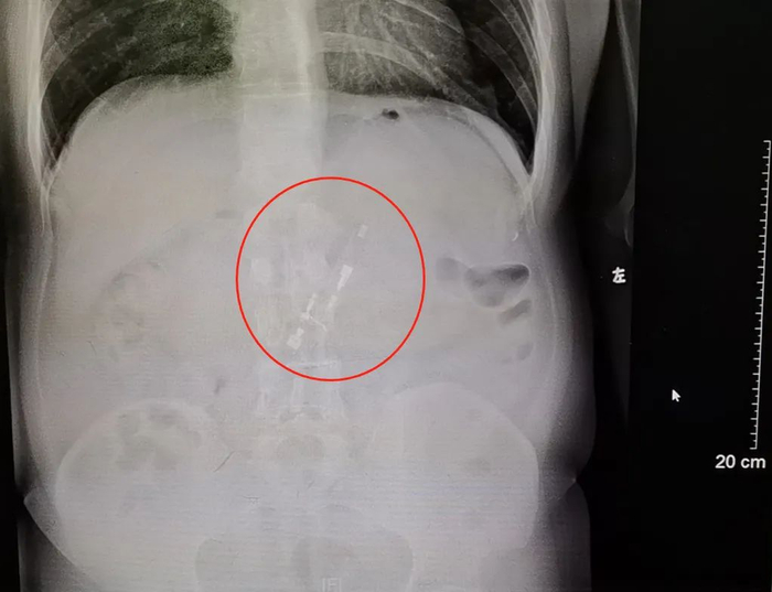 X光片显示，胃里有个白色条形物质。通讯员供图