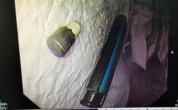 打火机被完整取出。通讯员供图