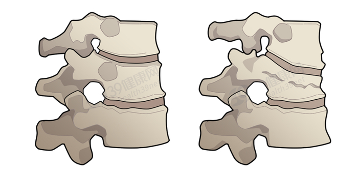 脊椎骨压缩性骨折这是因为骨质疏松会导致再见面发现比他矮了半个头