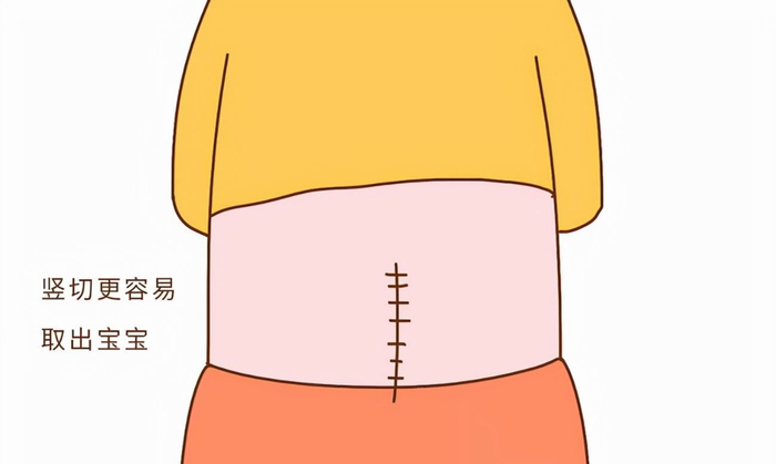 剖腹产后禁忌事项 宝妈恢复注意事项