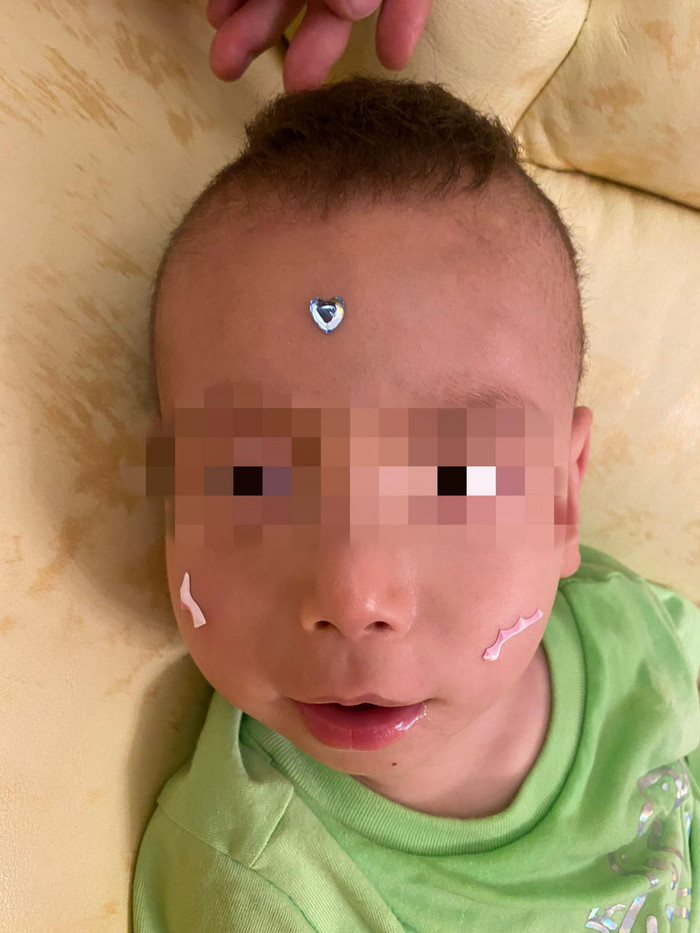 Menkes患儿徐灏洋。受访者供图