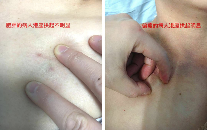 为什么20ml针筒的针在边上蝶翼针穿刺:为何一针下去却没回血?_新闻资讯_第4张_活检穿刺产品网 为什么20ml针筒的针在边上蝶翼针穿刺:为何一针下去却没回血?_https://www.jmylbn.com_新闻资讯_第4张