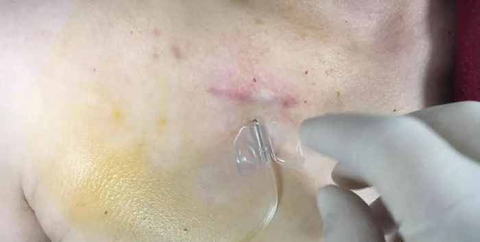 为什么20ml针筒的针在边上蝶翼针穿刺:为何一针下去却没回血?_新闻资讯_第1张_活检穿刺产品网 为什么20ml针筒的针在边上蝶翼针穿刺:为何一针下去却没回血?_https://www.jmylbn.com_新闻资讯_第1张