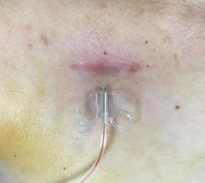 为什么20ml针筒的针在边上蝶翼针穿刺:为何一针下去却没回血?_新闻资讯_第2张_活检穿刺产品网 为什么20ml针筒的针在边上蝶翼针穿刺:为何一针下去却没回血?_https://www.jmylbn.com_新闻资讯_第2张