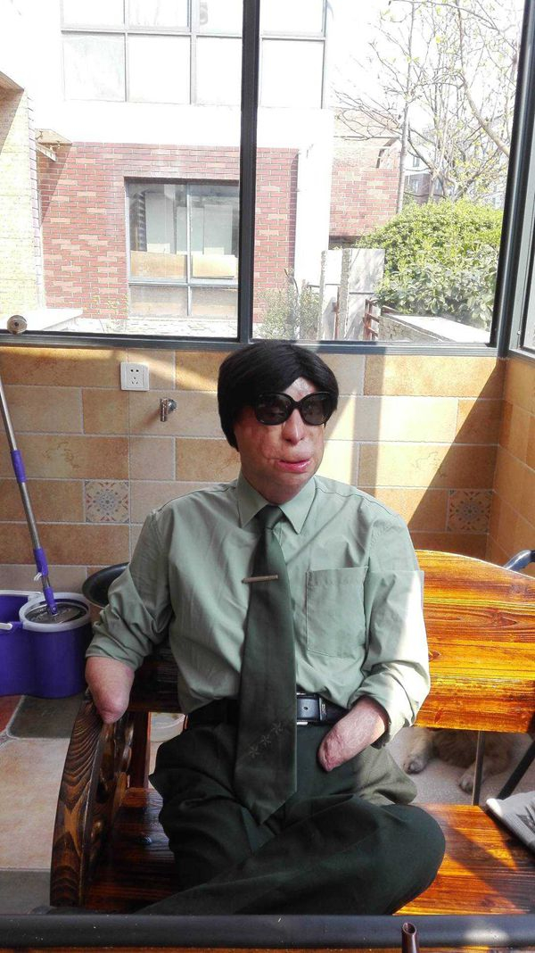 因抢救战友不满40天的婴儿，刘琦被烧伤致残