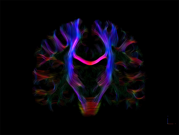 联影3.0T磁共振脑神经纤维断面扩散张量成像