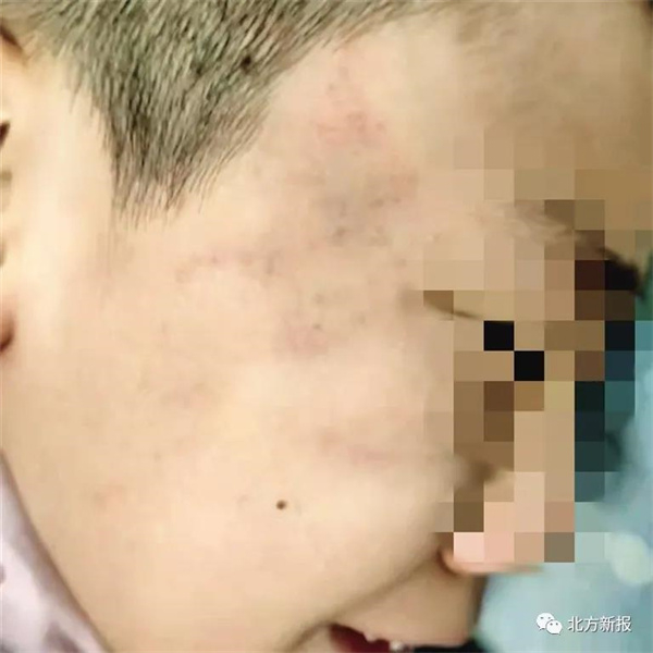男孩脸被扇耳光后留下的青紫痕迹