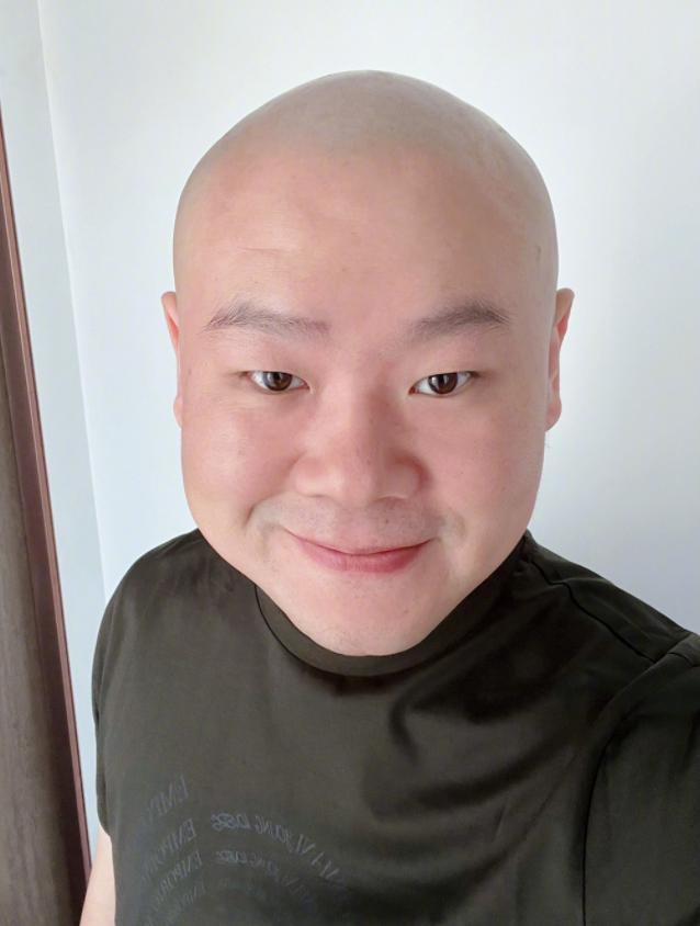 岳云鹏光头造型引发网友关心，本尊录视频回应：因手术“暂停营业”-岳云鹏薅头发